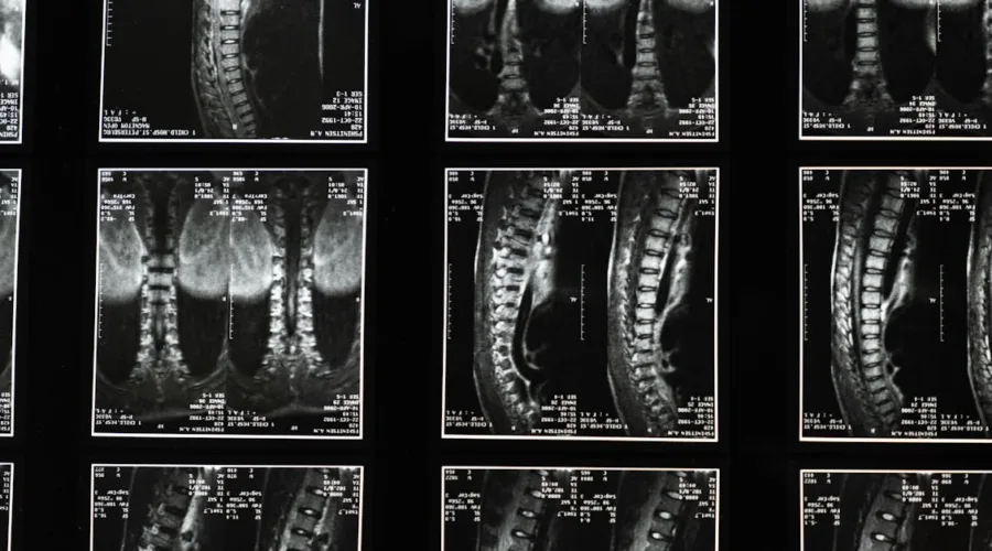 découvrez tout sur la sciatique : causes, symptômes, traitements et conseils pour soulager la douleur sciatique. informez-vous sur les meilleures pratiques pour prévenir et gérer cette affection courante.